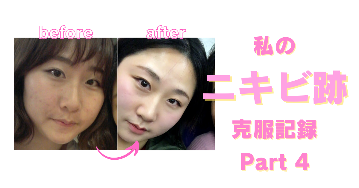 ニキビ